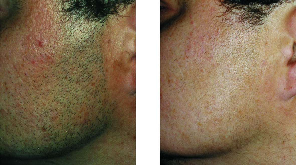 depilacja laserowa przed i po 4 zabiegach