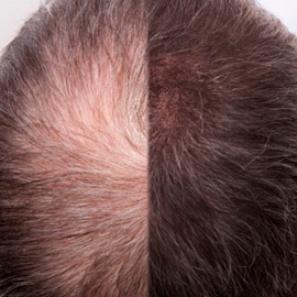 karboksyterapia na wypadanie włosów