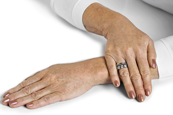 karboksyterapia regeneracja dłoni