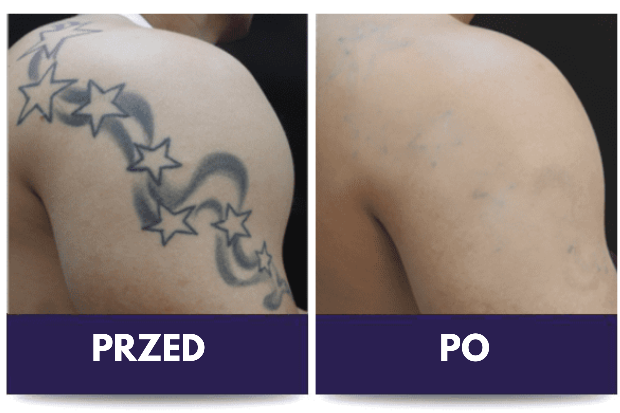 Usuwanie tatuaży i makijażu permanentnego